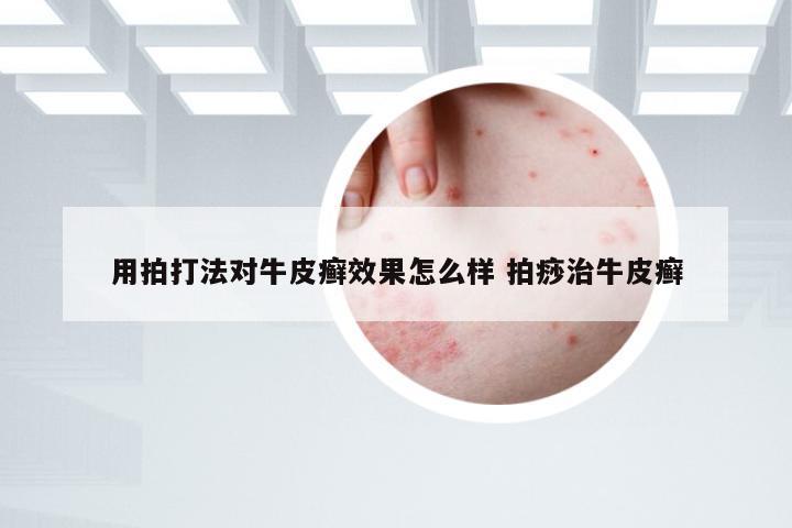 用拍打法对牛皮癣效果怎么样 拍痧治牛皮癣