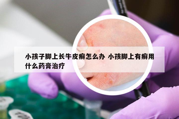 小孩子脚上长牛皮癣怎么办 小孩脚上有癣用什么药膏治疗