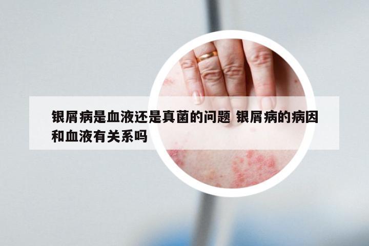 银屑病是血液还是真菌的问题 银屑病的病因和血液有关系吗
