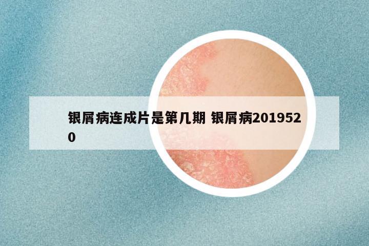 银屑病连成片是第几期 银屑病2019520