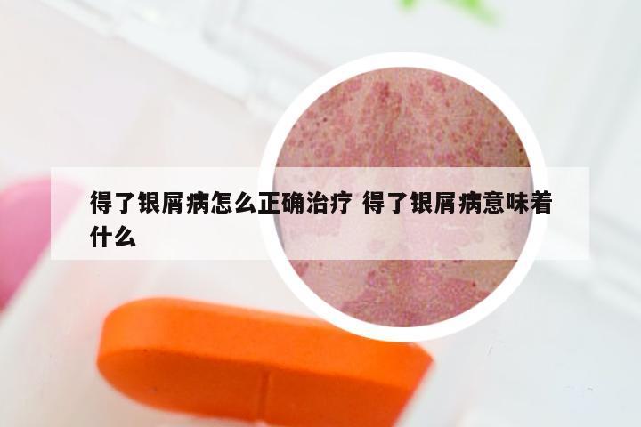 得了银屑病怎么正确治疗 得了银屑病意味着什么