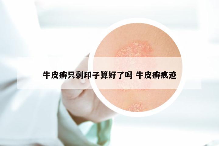 牛皮癣只剩印子算好了吗 牛皮癣痕迹