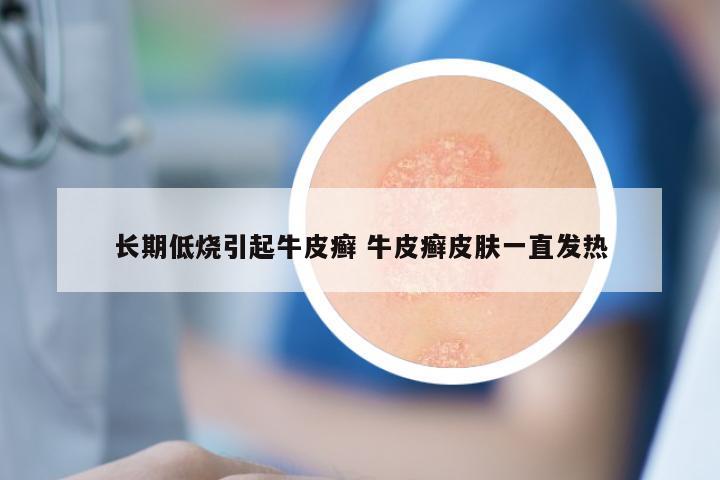 长期低烧引起牛皮癣 牛皮癣皮肤一直发热