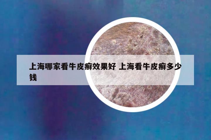 上海哪家看牛皮癣效果好 上海看牛皮癣多少钱