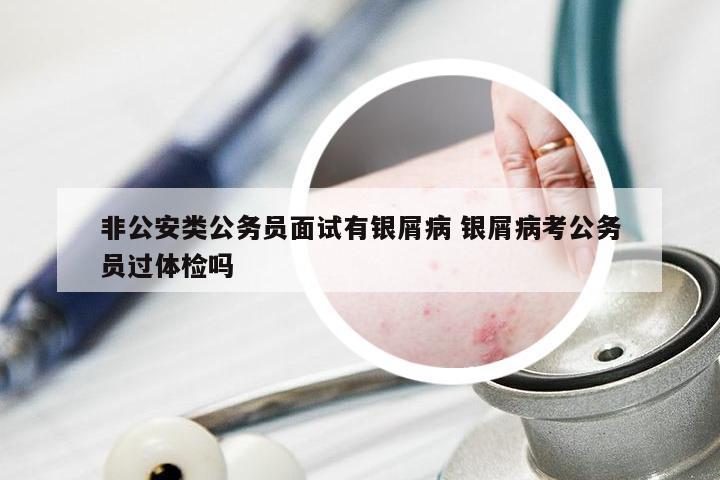 非公安类公务员面试有银屑病 银屑病考公务员过体检吗