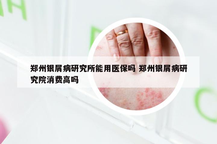郑州银屑病研究所能用医保吗 郑州银屑病研究院消费高吗