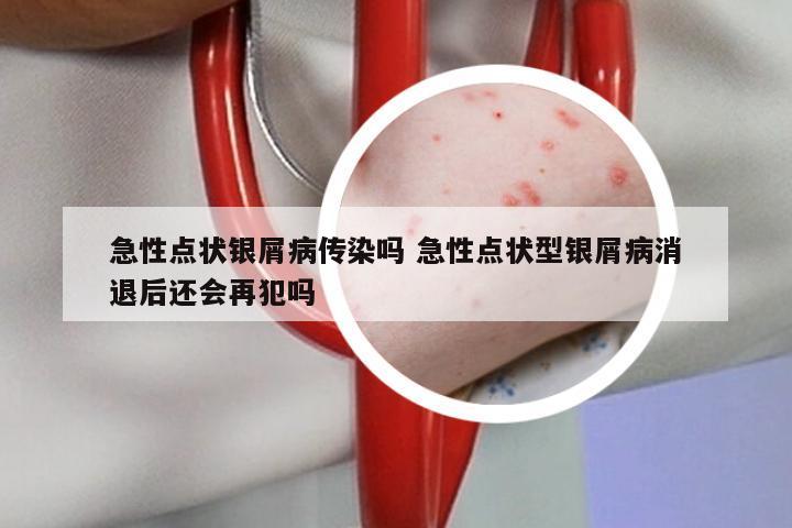 急性点状银屑病传染吗 急性点状型银屑病消退后还会再犯吗