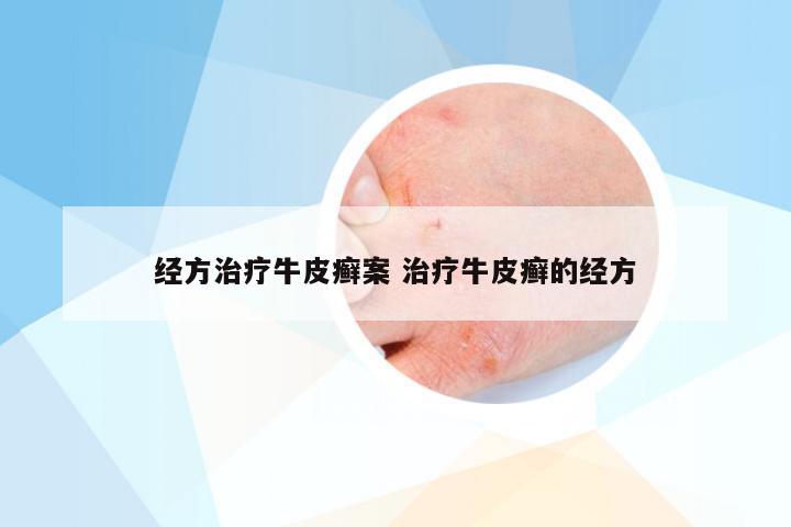 经方治疗牛皮癣案 治疗牛皮癣的经方