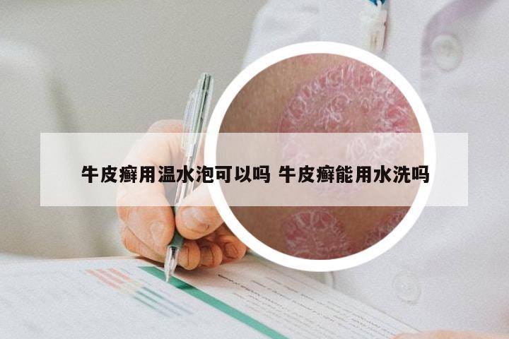 牛皮癣用温水泡可以吗 牛皮癣能用水洗吗