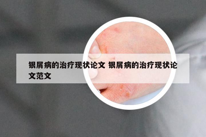 银屑病的治疗现状论文 银屑病的治疗现状论文范文
