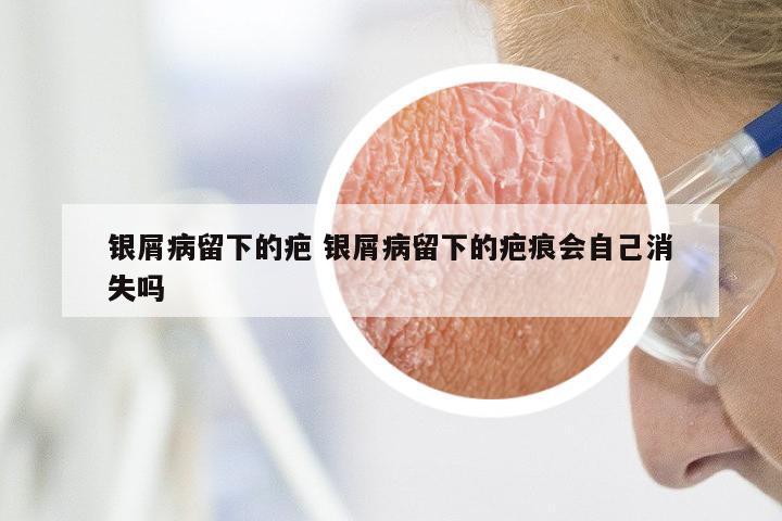 银屑病留下的疤 银屑病留下的疤痕会自己消失吗
