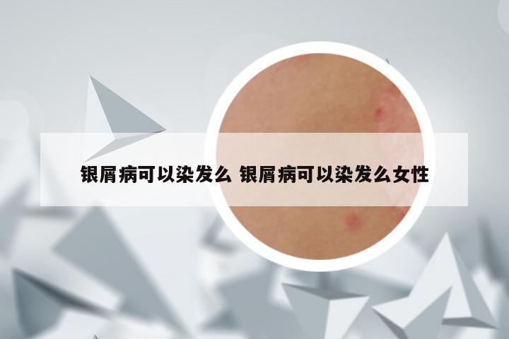 银屑病可以染发么 银屑病可以染发么女性