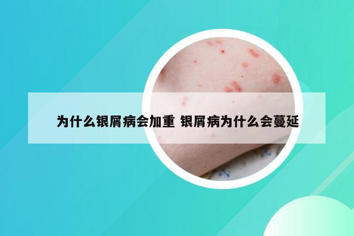 为什么银屑病会加重 银屑病为什么会蔓延