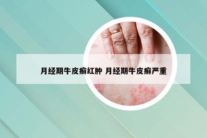 月经期牛皮癣红肿 月经期牛皮癣严重