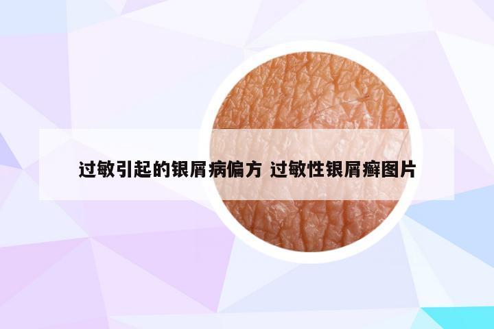 过敏引起的银屑病偏方 过敏性银屑癣图片