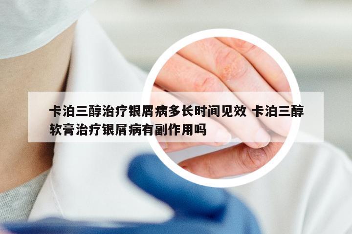 卡泊三醇治疗银屑病多长时间见效 卡泊三醇软膏治疗银屑病有副作用吗
