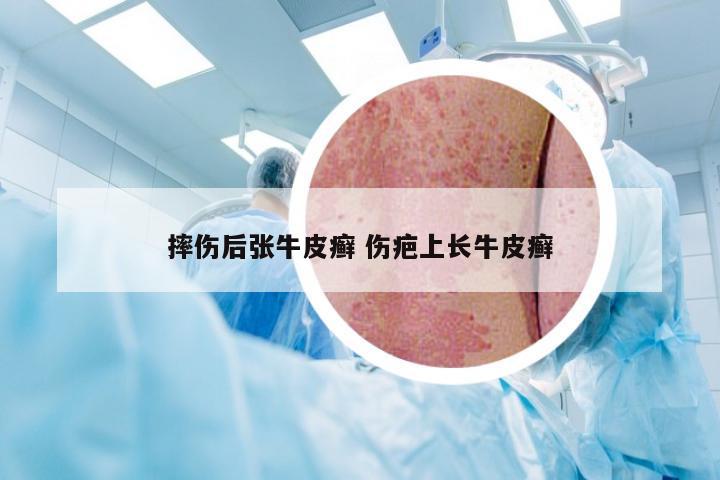 摔伤后张牛皮癣 伤疤上长牛皮癣
