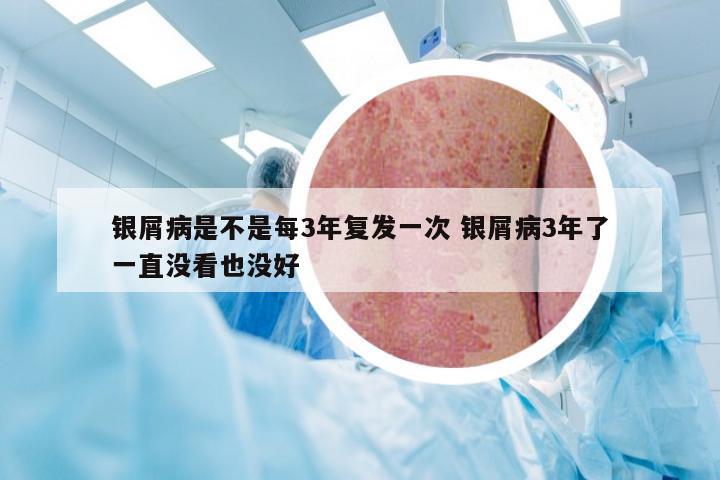 银屑病是不是每3年复发一次 银屑病3年了一直没看也没好