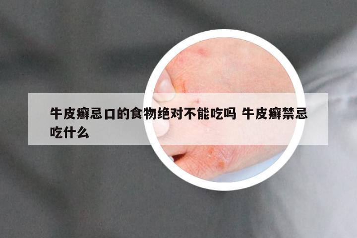 牛皮癣忌口的食物绝对不能吃吗 牛皮癣禁忌吃什么