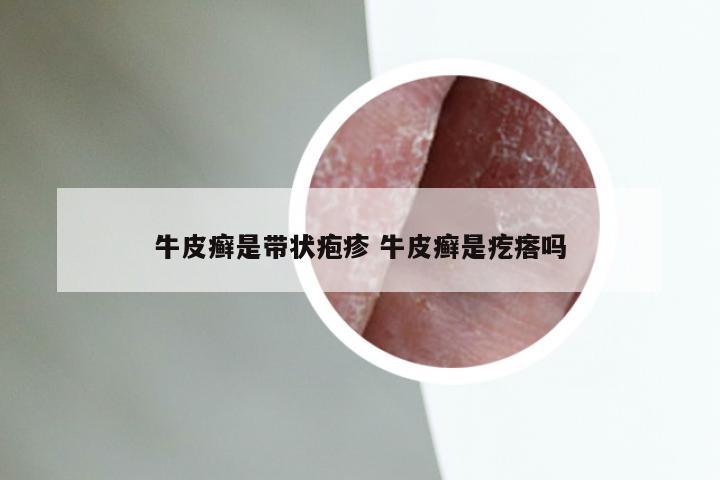 牛皮癣是带状疱疹 牛皮癣是疙瘩吗