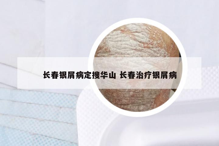 长春银屑病定搜华山 长春治疗银屑病