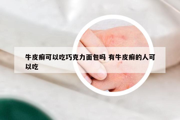 牛皮癣可以吃巧克力面包吗 有牛皮癣的人可以吃