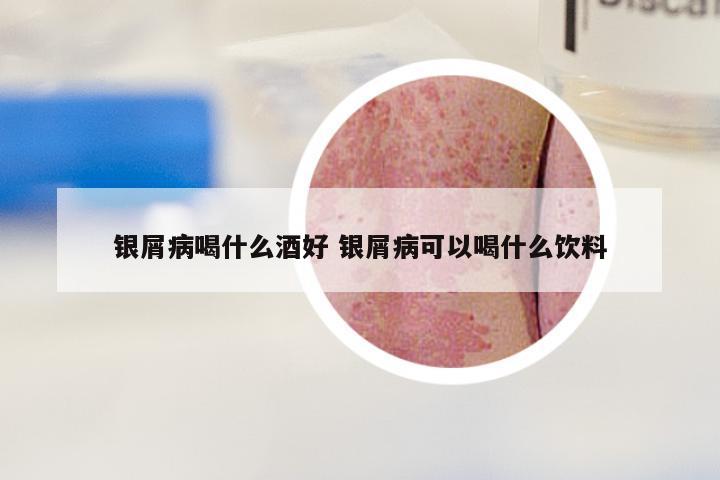 银屑病喝什么酒好 银屑病可以喝什么饮料