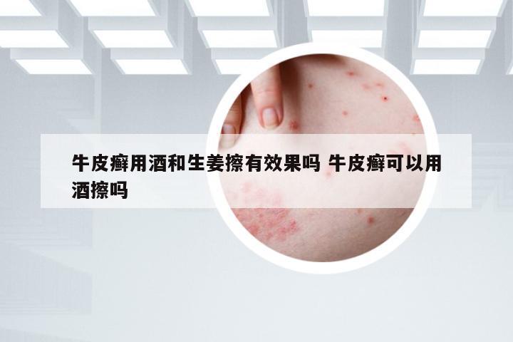 牛皮癣用酒和生姜擦有效果吗 牛皮癣可以用酒擦吗