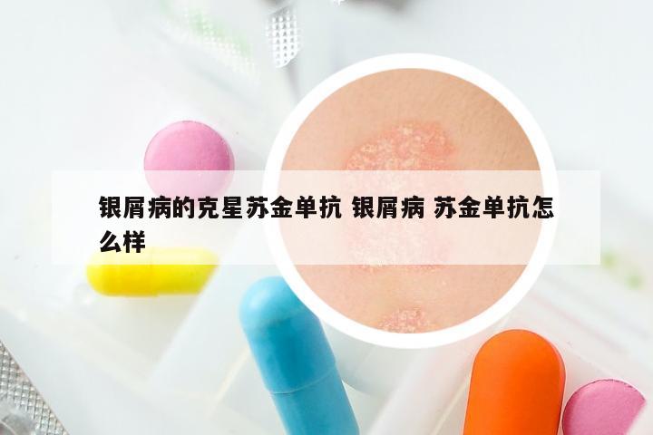 银屑病的克星苏金单抗 银屑病 苏金单抗怎么样