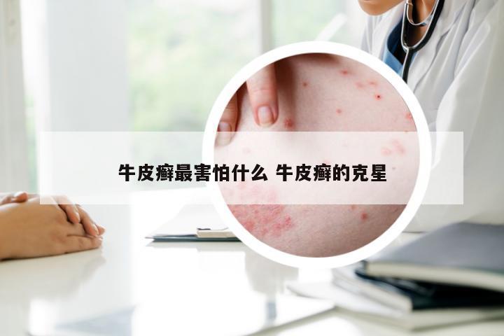 牛皮癣最害怕什么 牛皮癣的克星