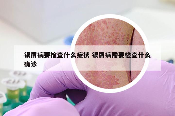 银屑病要检查什么症状 银屑病需要检查什么确诊