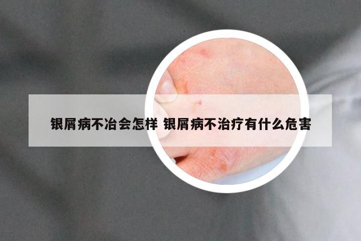 银屑病不冶会怎样 银屑病不治疗有什么危害