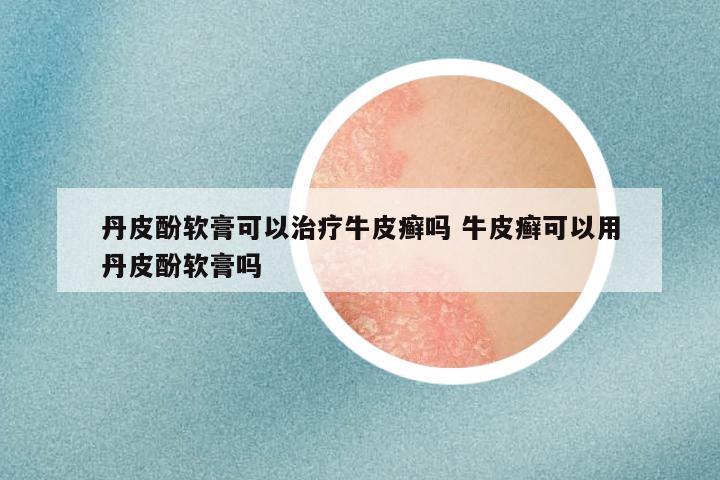 丹皮酚软膏可以治疗牛皮癣吗 牛皮癣可以用丹皮酚软膏吗