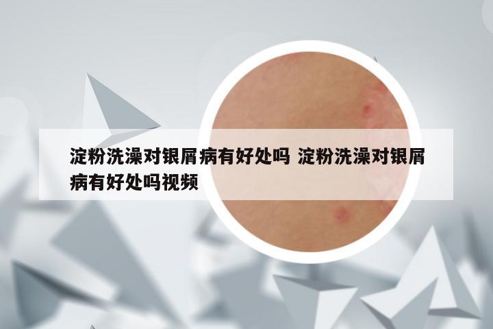 淀粉洗澡对银屑病有好处吗 淀粉洗澡对银屑病有好处吗视频