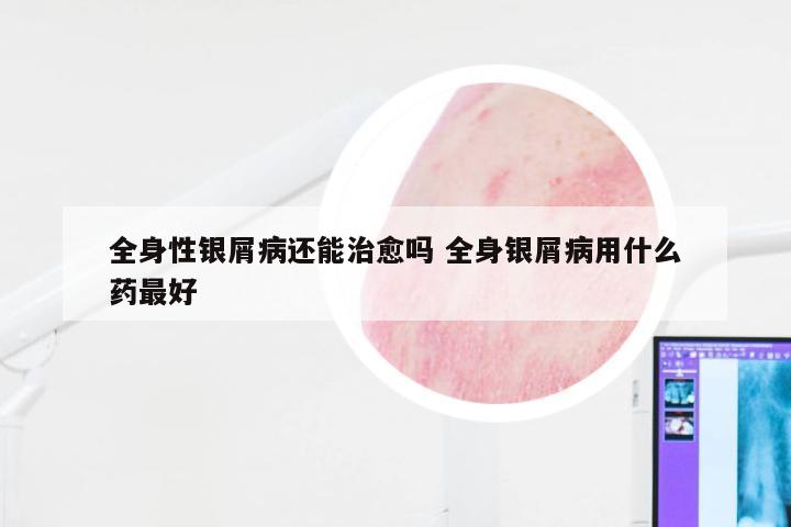 全身性银屑病还能治愈吗 全身银屑病用什么药最好
