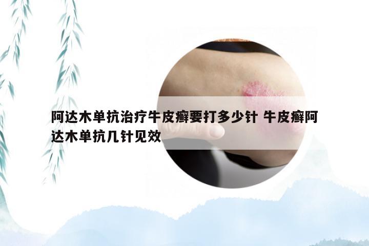 阿达木单抗治疗牛皮癣要打多少针 牛皮癣阿达木单抗几针见效