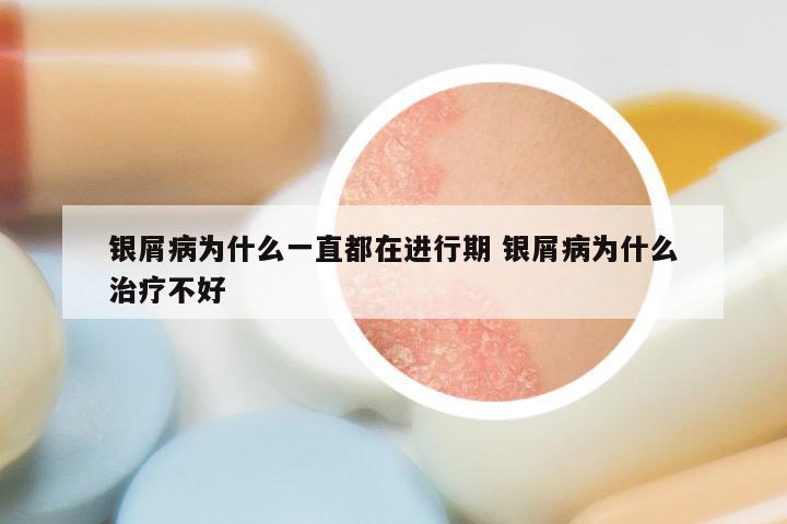 银屑病为什么一直都在进行期 银屑病为什么治疗不好