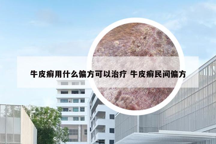 牛皮癣用什么偏方可以治疗 牛皮癣民间偏方