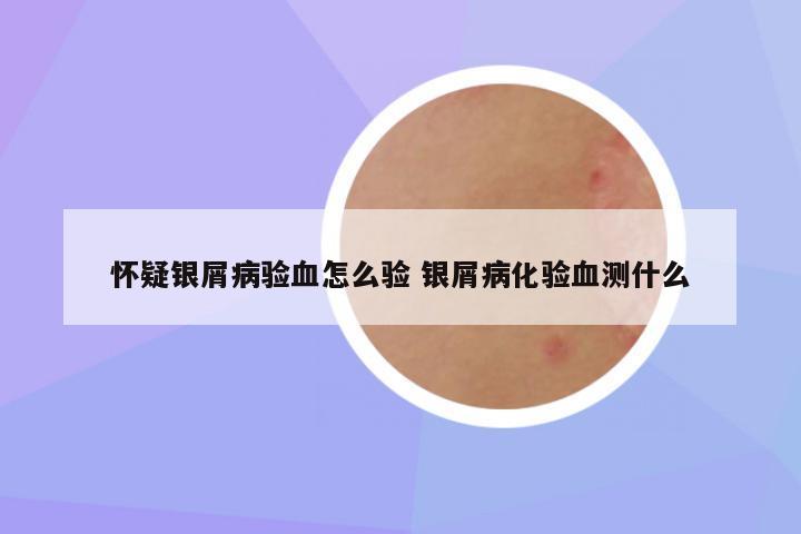 怀疑银屑病验血怎么验 银屑病化验血测什么