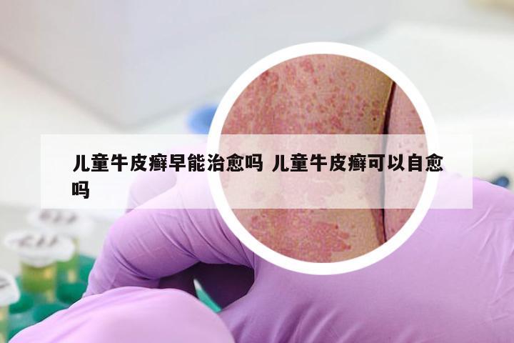 儿童牛皮癣早能治愈吗 儿童牛皮癣可以自愈吗