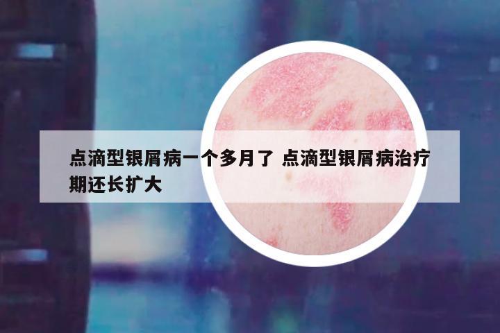 点滴型银屑病一个多月了 点滴型银屑病治疗期还长扩大