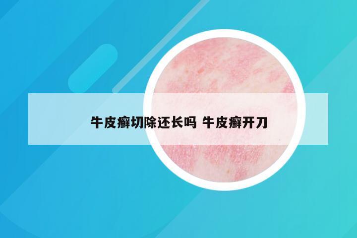 牛皮癣切除还长吗 牛皮癣开刀