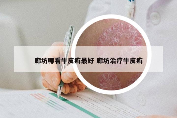 廊坊哪看牛皮癣最好 廊坊治疗牛皮癣
