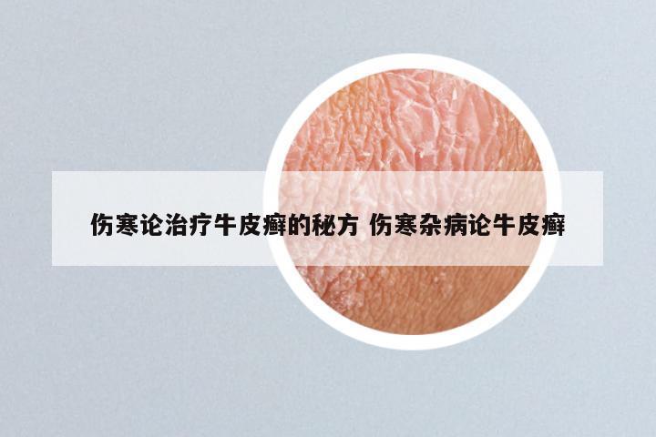 伤寒论治疗牛皮癣的秘方 伤寒杂病论牛皮癣