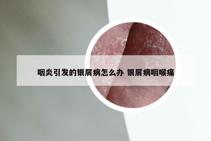 咽炎引发的银屑病怎么办 银屑病咽喉痛