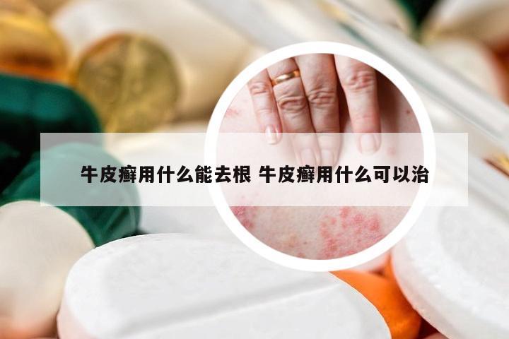 牛皮癣用什么能去根 牛皮癣用什么可以治