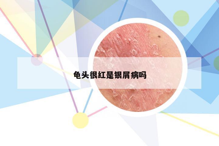 龟头很红是银屑病吗