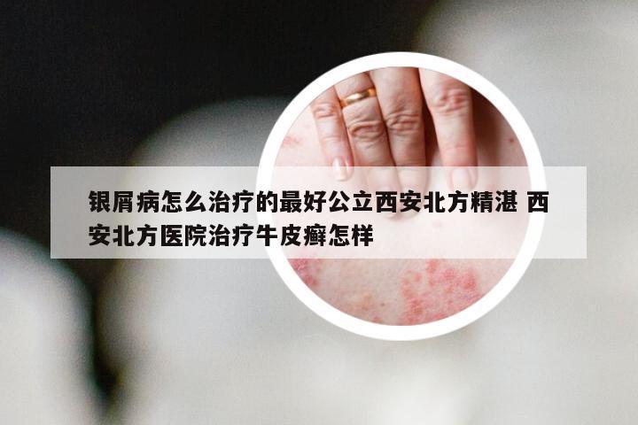 银屑病怎么治疗的最好公立西安北方精湛 西安北方医院治疗牛皮癣怎样