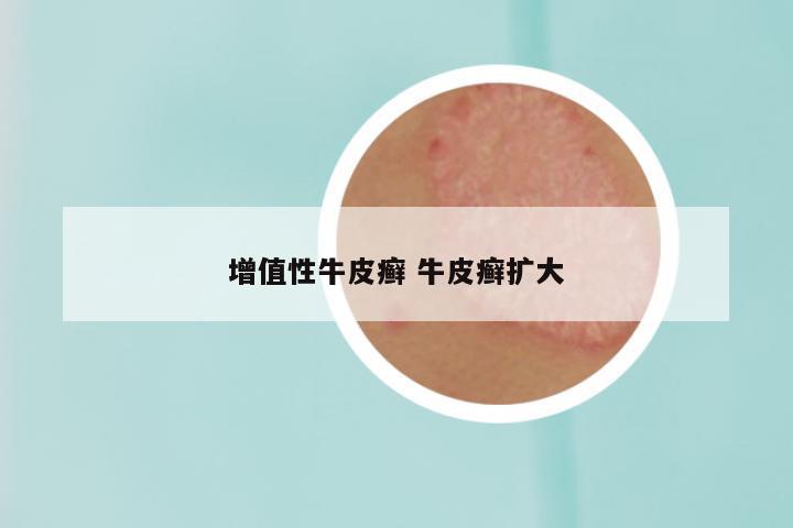 增值性牛皮癣 牛皮癣扩大