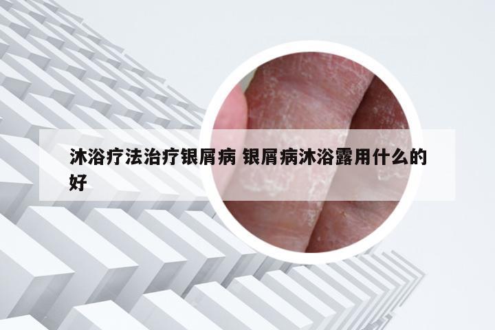 沐浴疗法治疗银屑病 银屑病沐浴露用什么的好
